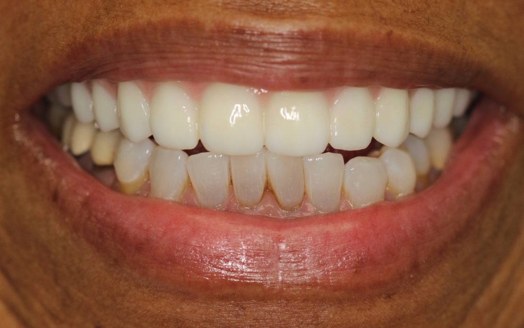 All on 4 – Female – Before and After Photos