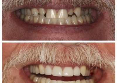 Before And After Male Porcelain Veneers